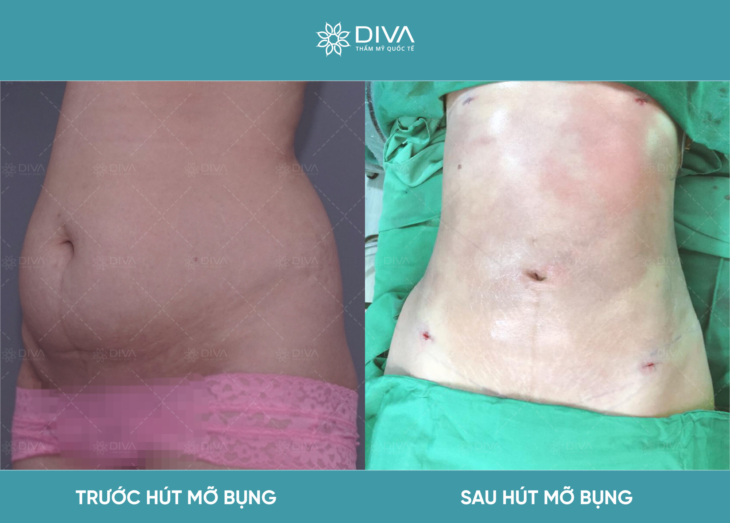 hút bớt mỡ
